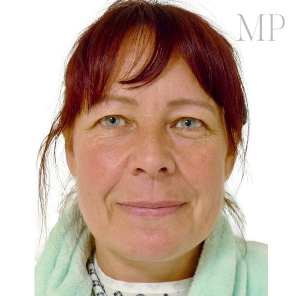 Upper-Blepharoplsaty-Patient-4-Before