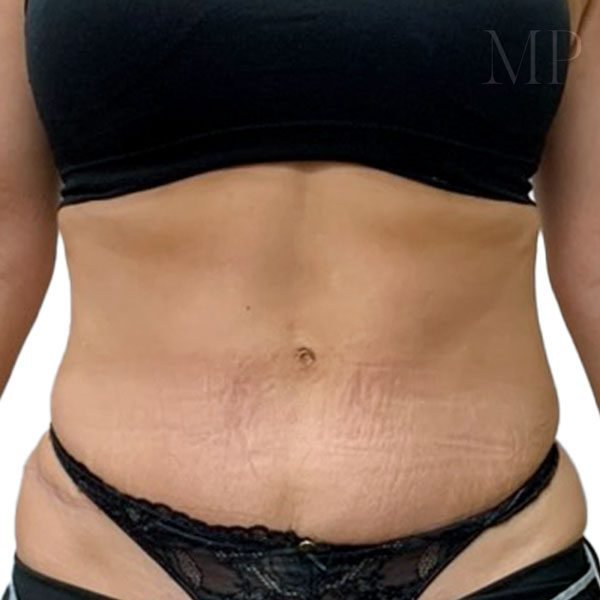 abdominoplasty-7-post-op-