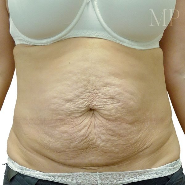 abdominoplsty-7-pre-op-