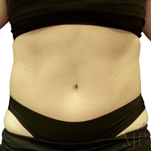 abdominoplsty-8-post-op-
