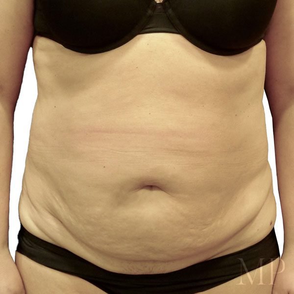 abdominoplsty-8-pre-op-