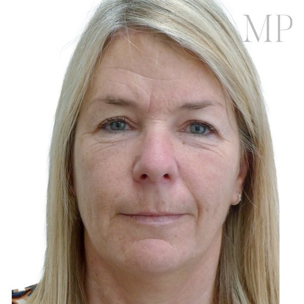 brow-lift-patient-2-after-