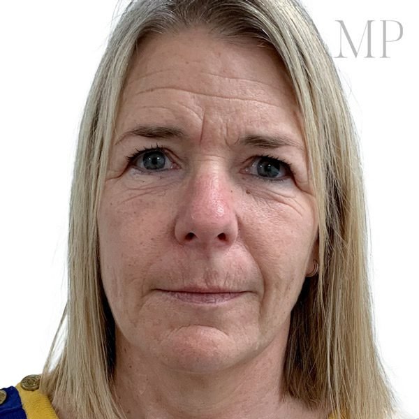 brow-lift-patient-2-before-