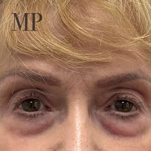 lower-lid-Bleph-pre-op-copy