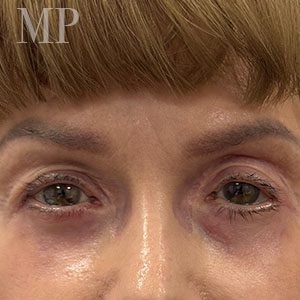 lower-lid-blepharoplasty-post-op-cropped-copy