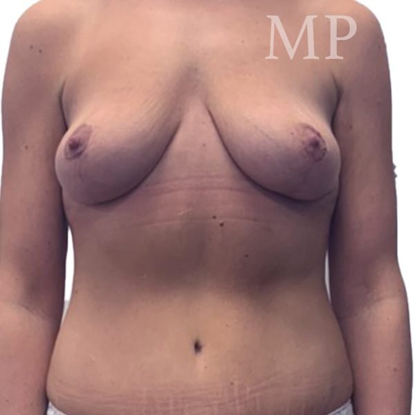mastopexy-abdominoplasty-LG-post-op_