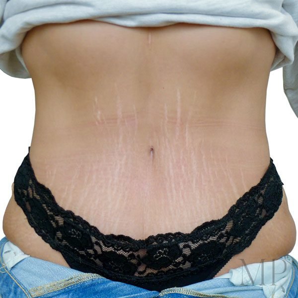 this-photograph-to-replace-the-post-op-on-the-fourth-abdominoplasty-case-please-